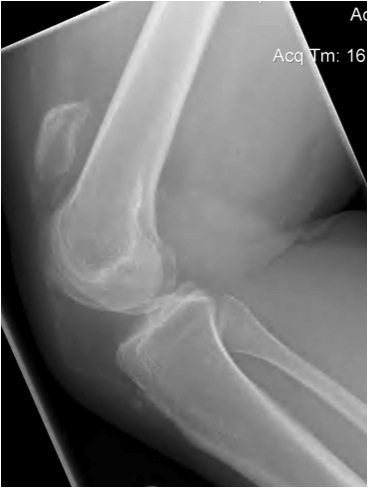 Chronic Patella Tendon Rupture Xray